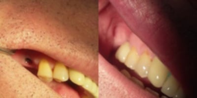 bob dyer | Los Algodones Dentists