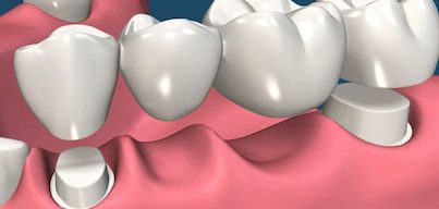 dental-bridges