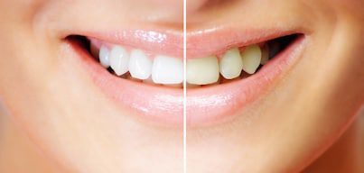 Teeth Withening - Before and After