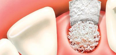 Bone Graft 2 e1430843745567 | Los Algodones Dentists