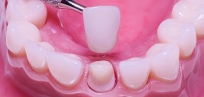 Dental Crowns in Mexico