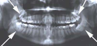 Wisdom-teeth-xray