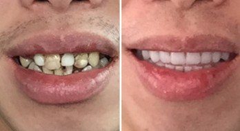 Modern dentistry results, just like natural teeth