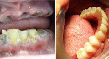 High Quality Dental Work - All-on-4 dental implant surgery