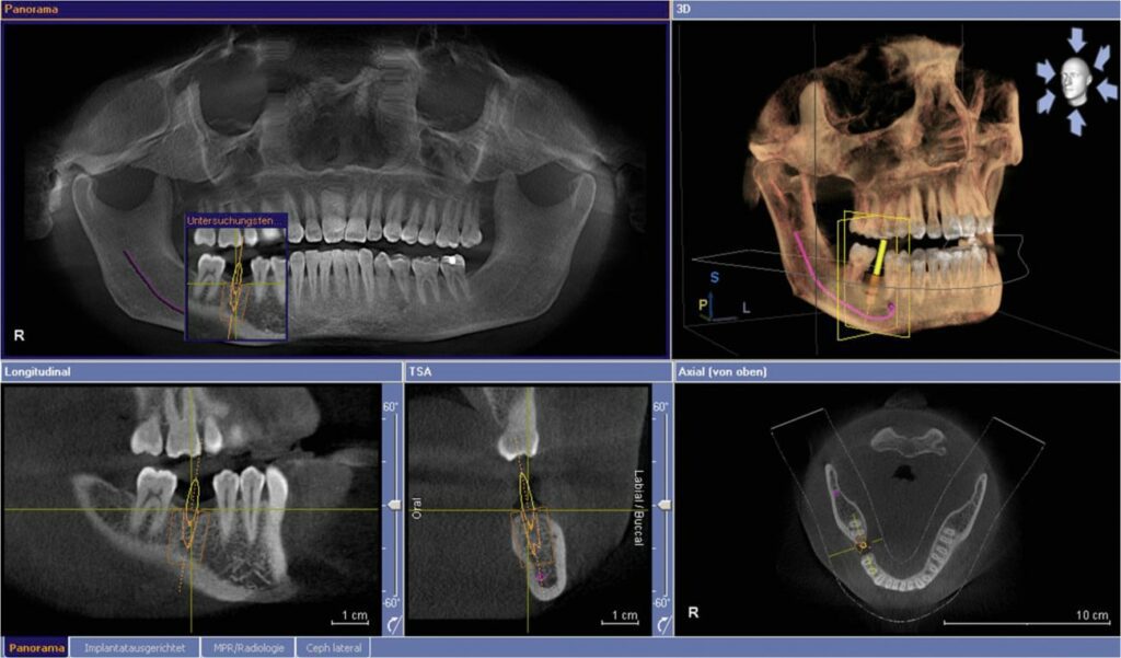 CT Scan Implant Planning | Los Algodones Dentists