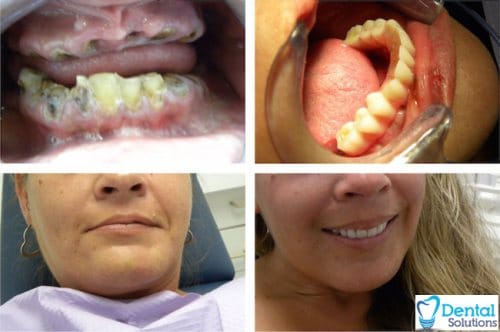 all on 4 before after | Dental Solutions Algodones