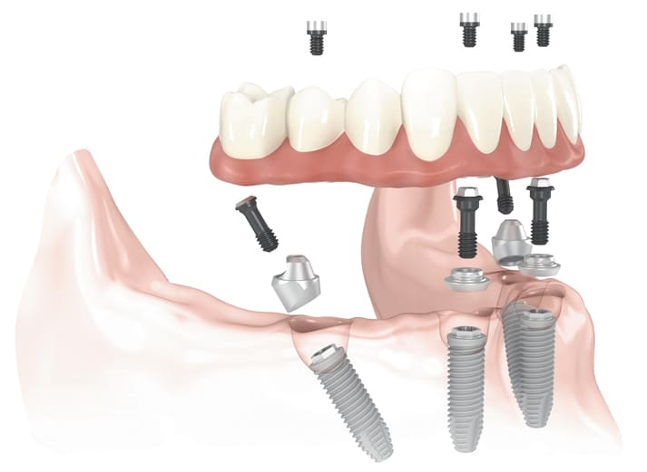 All-on-4 dental implants