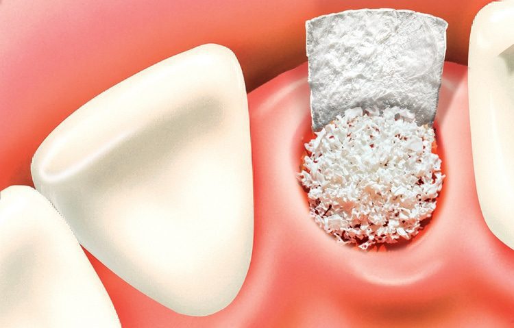 Bone grafting