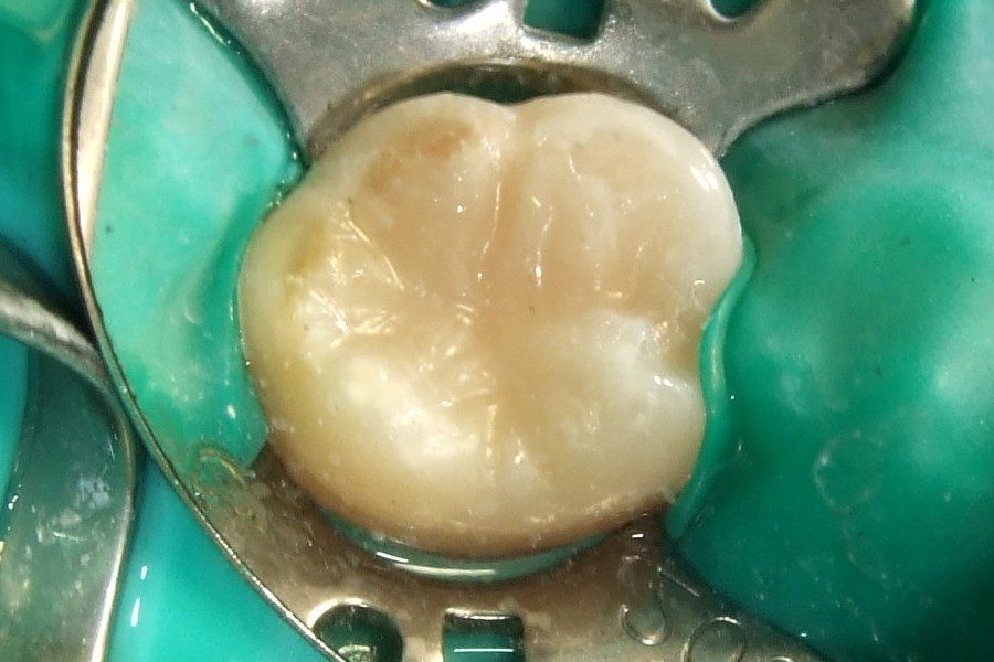 White Fillings and composite resin