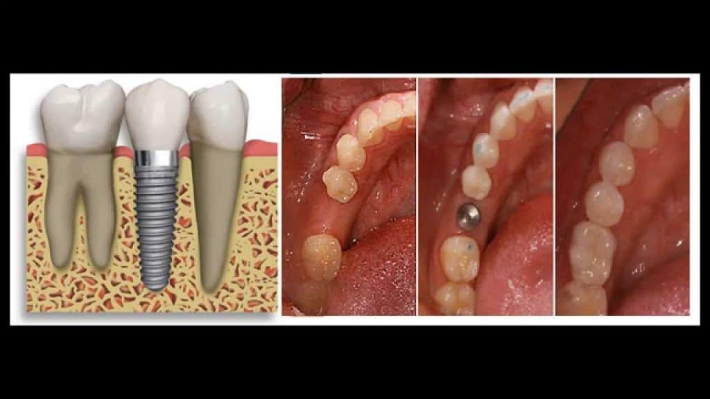 Dental Implant