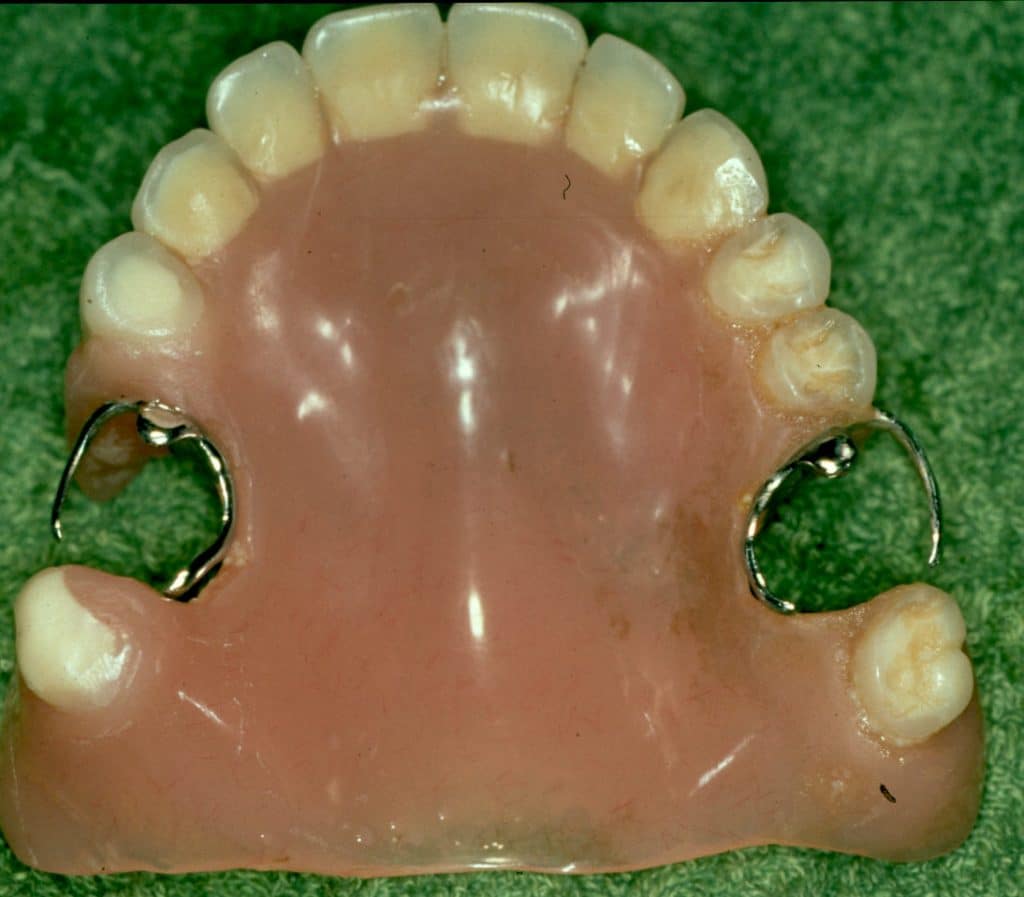 Removable partial acrylic resin denture 742 | Dental Solutions Algodones