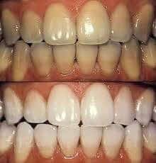 Discolored teeth and tooth coloration