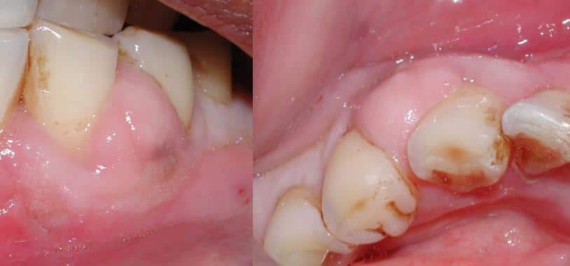 periodontal disease is related to diabetes