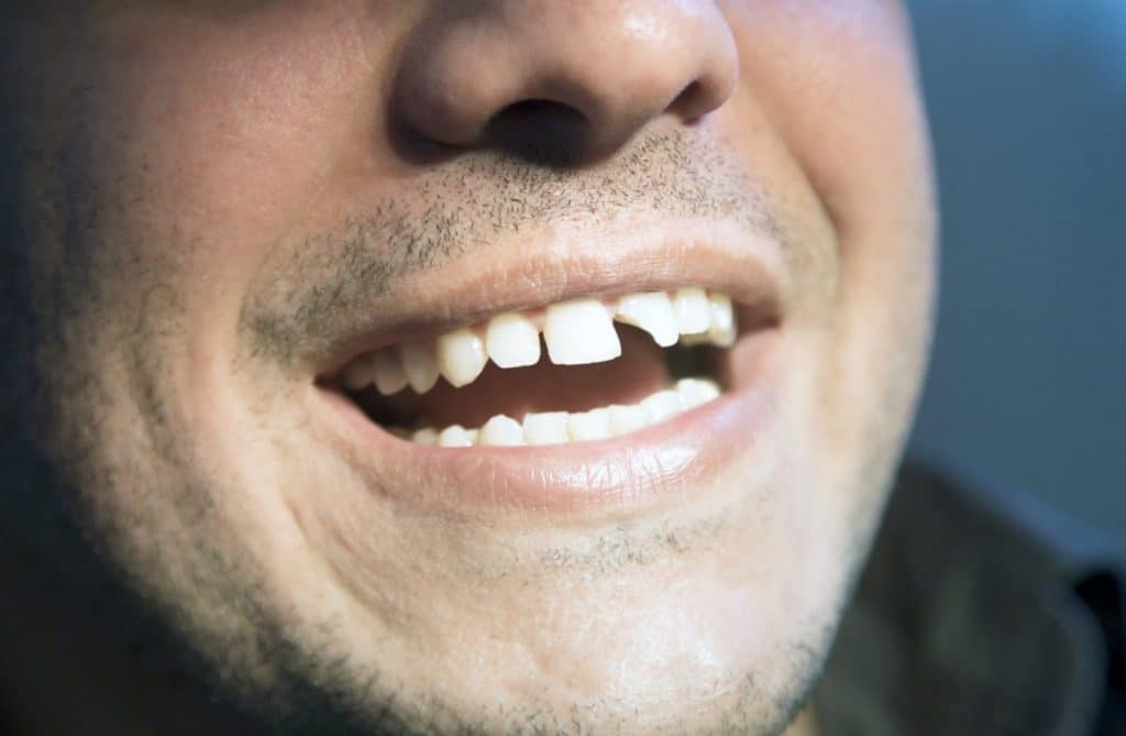 chipped | Dental Solutions Algodones