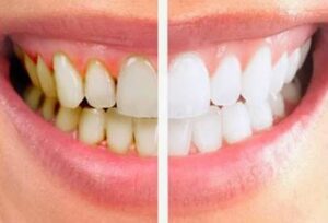 Remove Teeth Plaque | Los Algodones Dentists