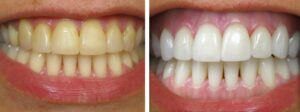 teethwhitening | Los Algodones Dentists