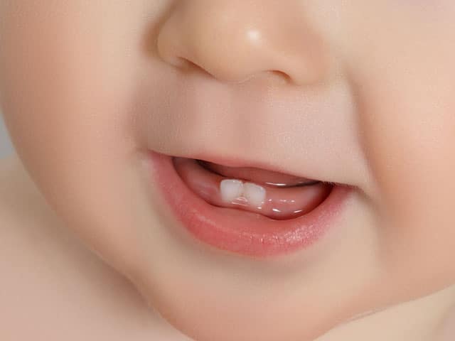 baby with two teeth | Dental Solutions Algodones