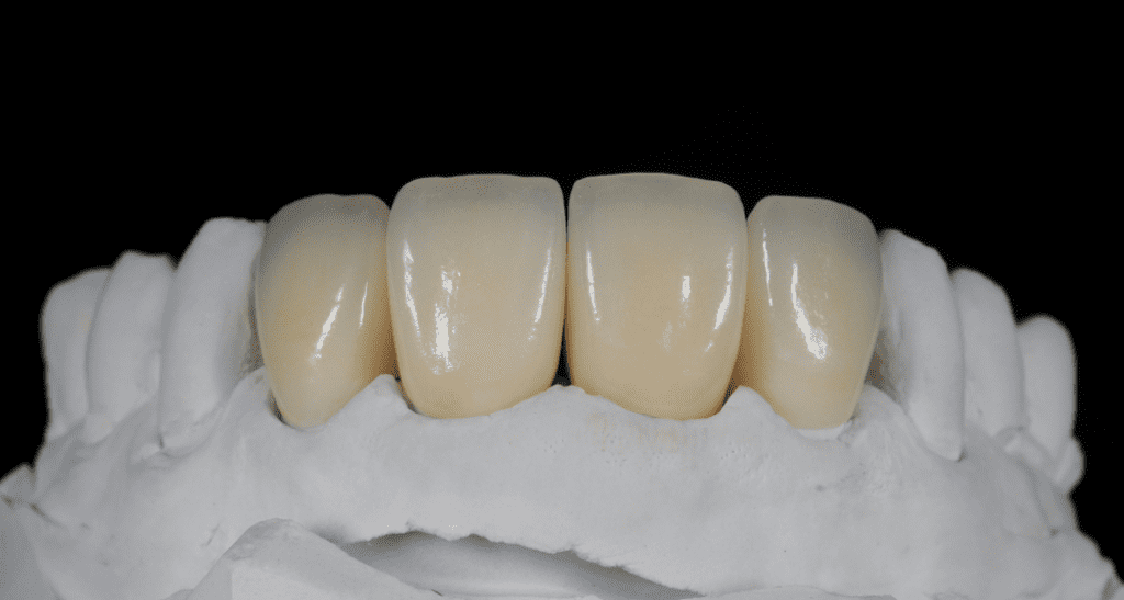 Dental crowns