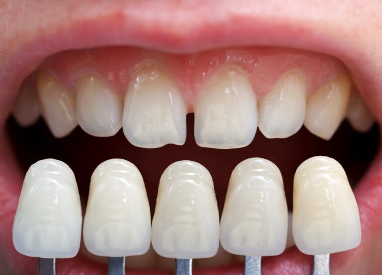 Know more about zirconia crowns Dental Solutions Algodones