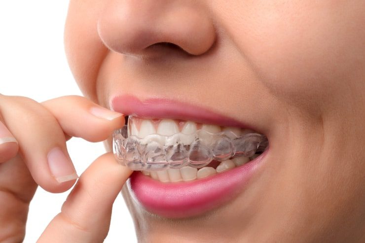 ferula bruxismo rechinar los dientes sanitum | Dental Solutions Algodones