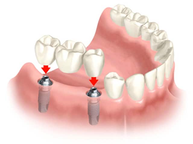 Dental Bridges