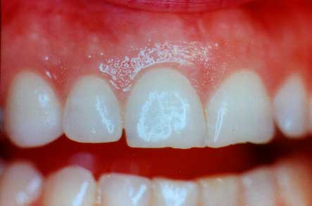 Maintain Healthy Gums and Teeth | Dental Solutions Algodones
