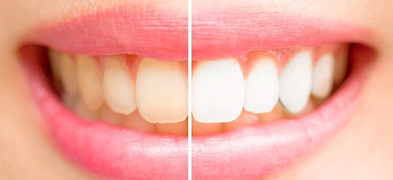 Why do I have yellow teeth? | Dental Solutions