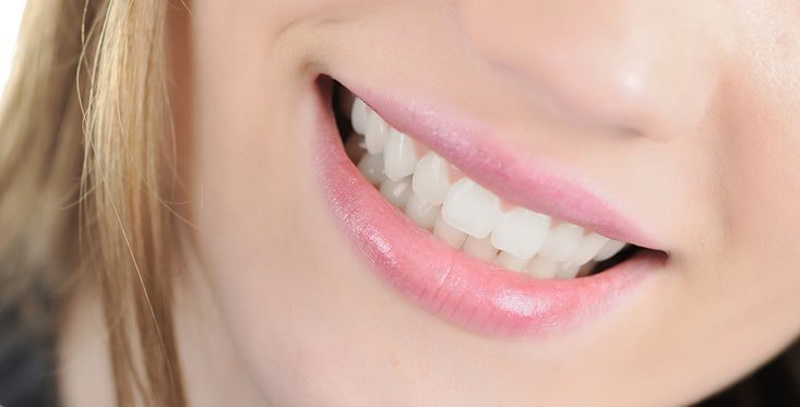 veneers | Dental Solutions Algodones