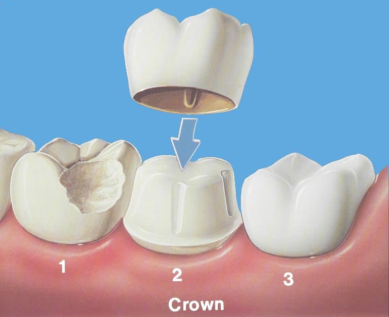 dental crown | Los Algodones Dentists