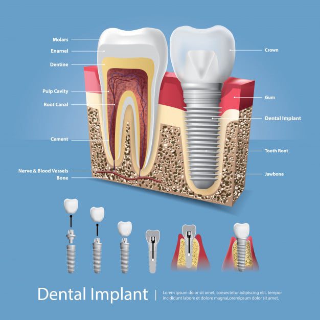 Dental implants | Dental Solutions Algodones