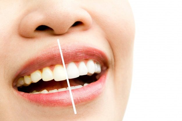 Teeth whitening1