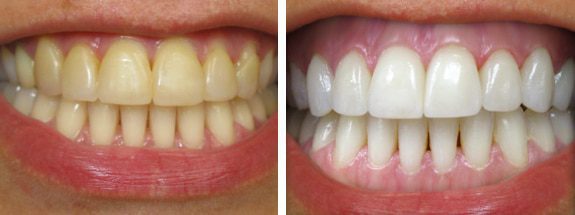 how to whiten teeth without baking soda