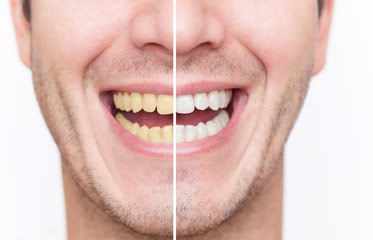 teeth whitening | Dental Solutions Algodones