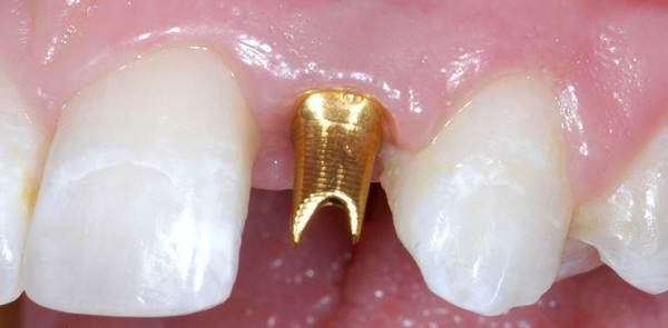 Can You Get Gold Dental Implants?