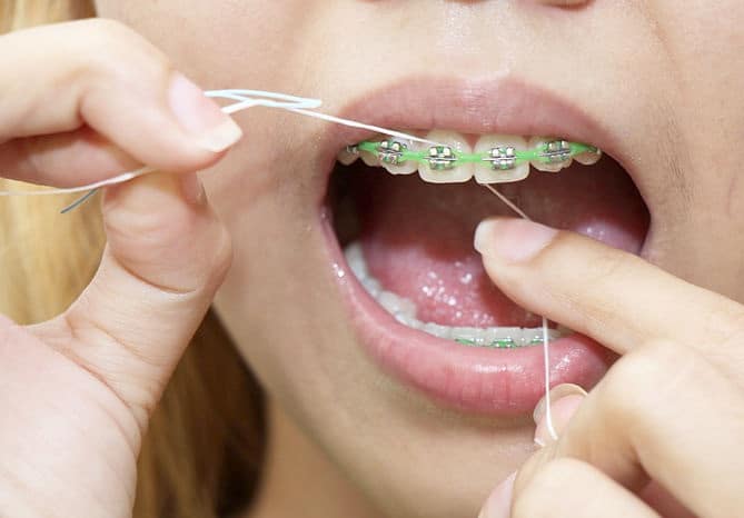 cleaning braces | Dental Solutions Algodones