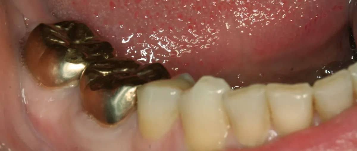 gold front tooth crown