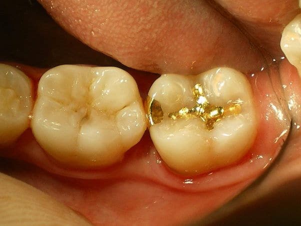 gold tooth filling