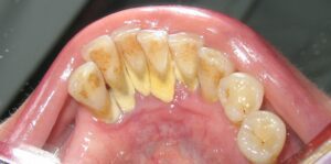 MandibularAnteriorCalculus | Dental Solutions Algodones