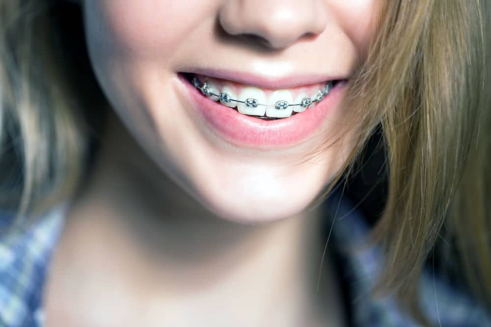 damon braces algodones | Dental Solutions Algodones