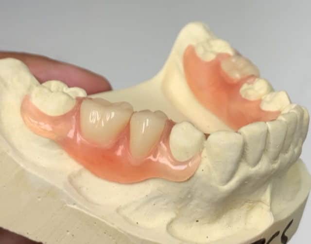 flexible partian dentures dental solutions | Dental Solutions Algodones