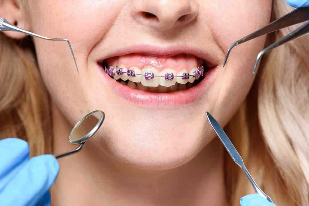 Orthodontic2 | Los Algodones Dentists