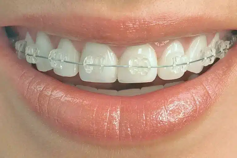 ceramic braces | Dental Solutions Algodones