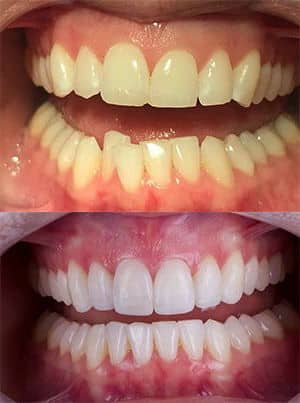 invisalign before after | Dental Solutions Algodones