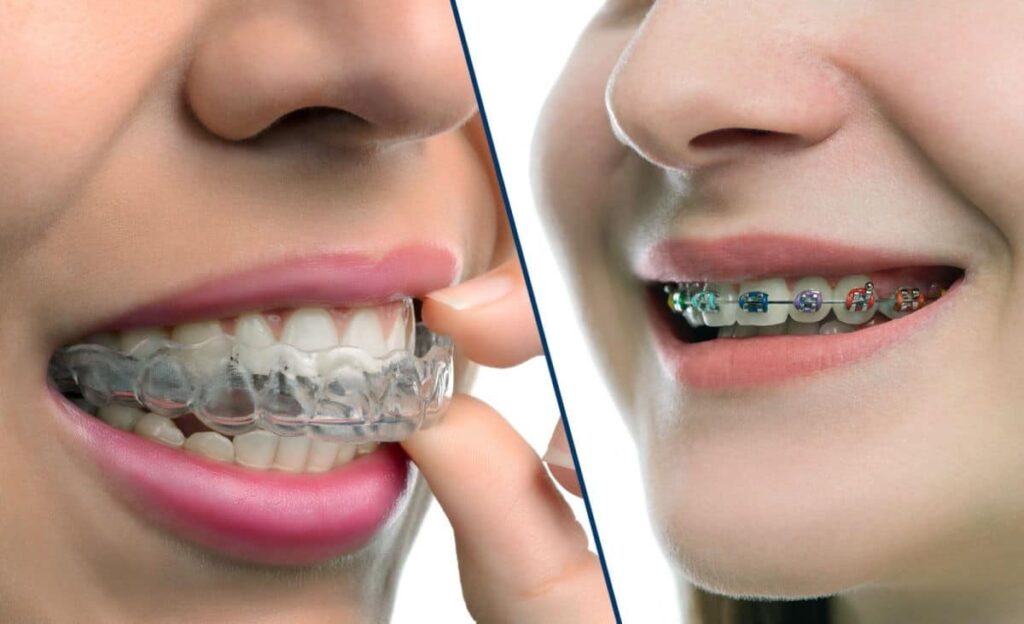 invisalign braces comparison | Los Algodones Dentists