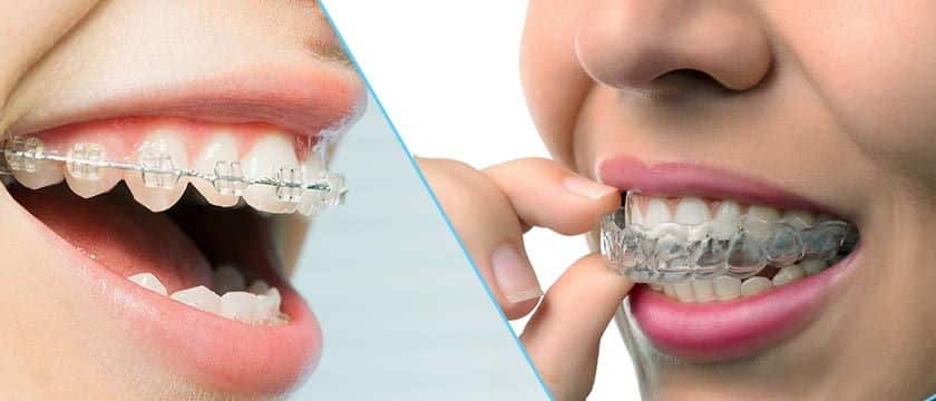 invisalign vs braces | Los Algodones Dentists