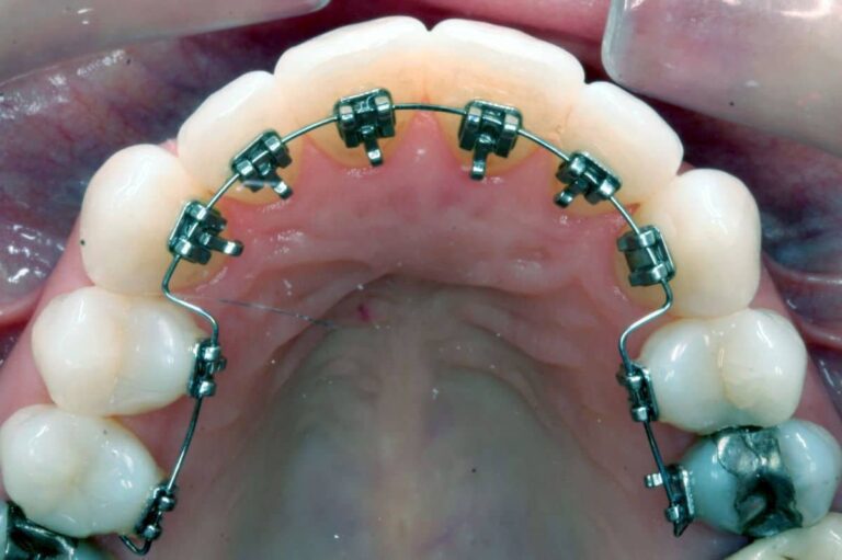 lingual braces orthodontics | Los Algodones Dentists
