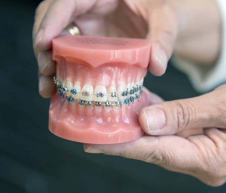 orthodontics braces | Los Algodones Dentists