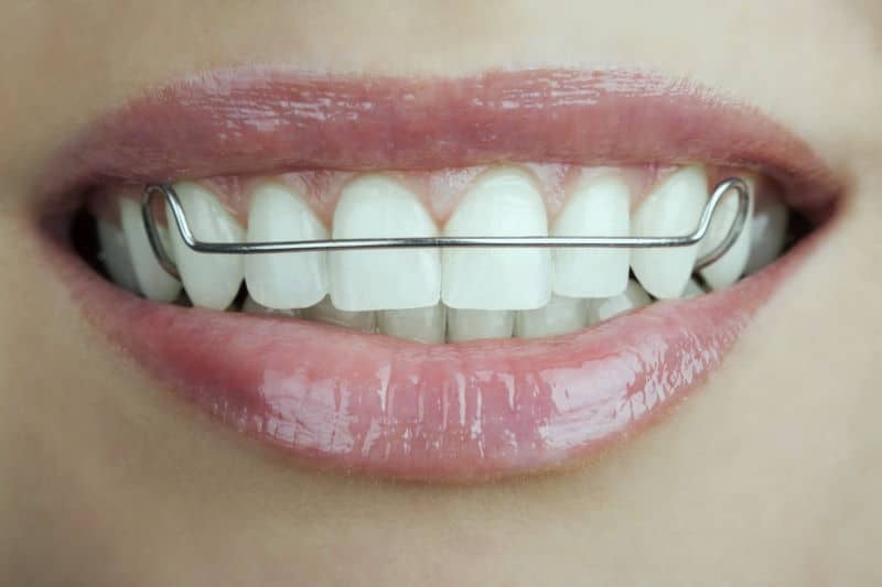 orthodontics retainers | Dental Solutions Algodones