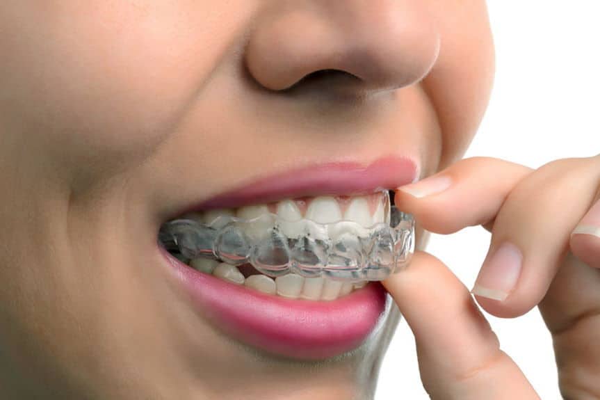 pros and cons of invisalign | Dental Solutions Algodones