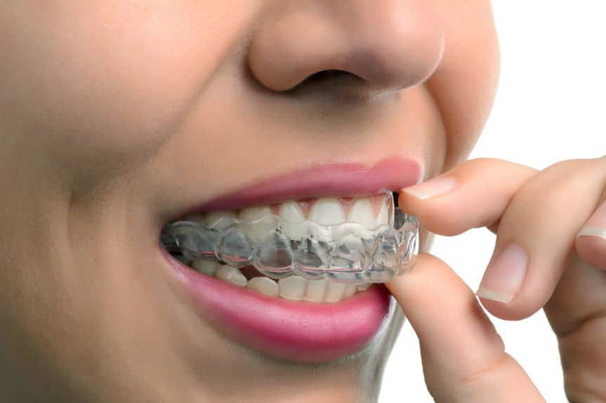 Orthodontics in Los Algodones